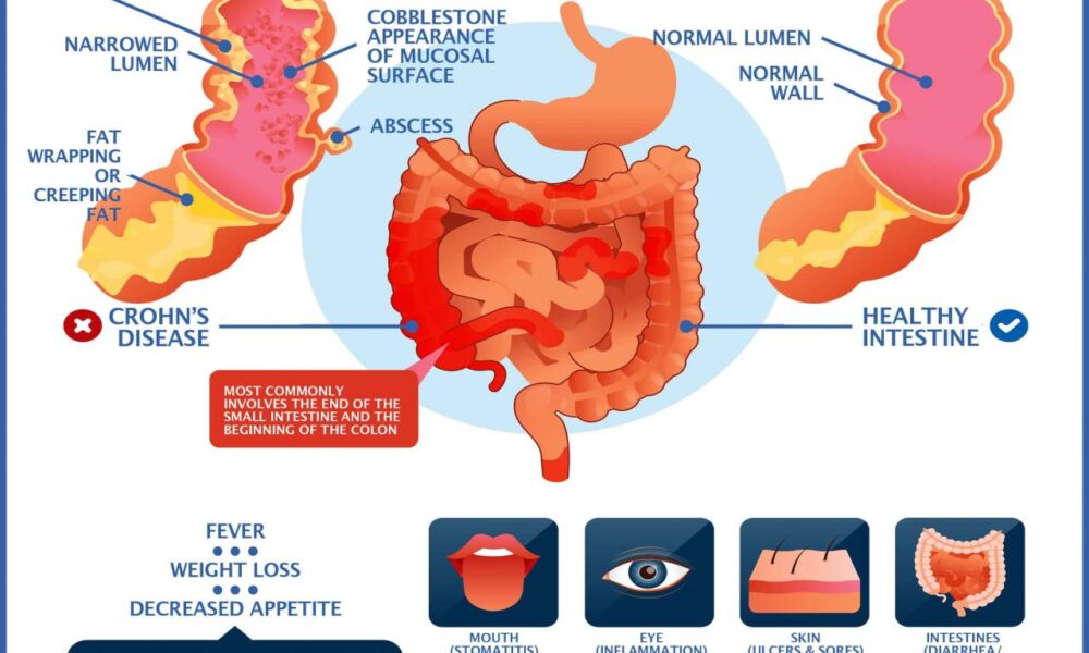 Crohn crohns treatment lindner verywell treated coping