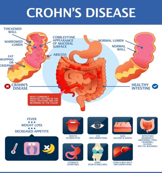 Crohn crohns treatment lindner verywell treated coping