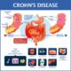 Crohn crohns treatment lindner verywell treated coping