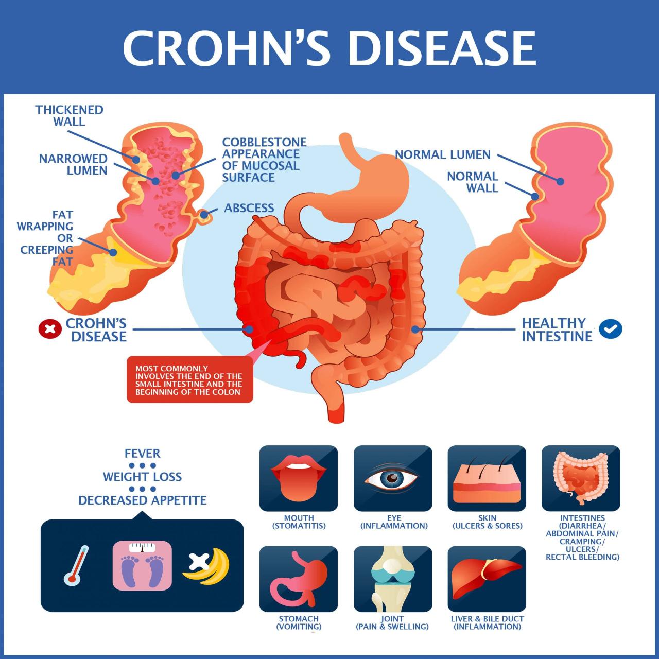 Crohn crohns treatment lindner verywell treated coping
